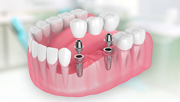 dental implant placement and maintenance