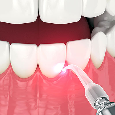 laser treatment of periodontal disease